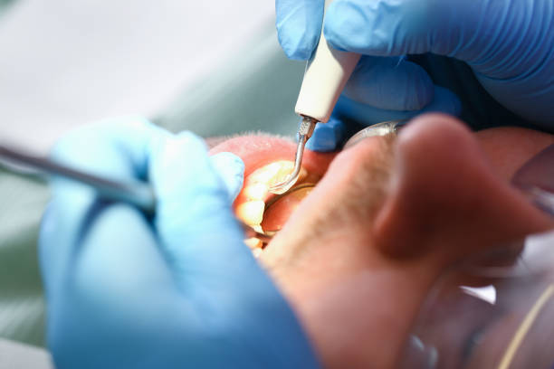 Best Emergency Dentist for Lost Fillings or Crowns in Minot, ND